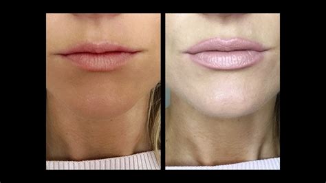 Lvaish Lip Magkc: The Secret to Youthful-Looking Lips
